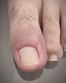 Operación uñas encarnadas