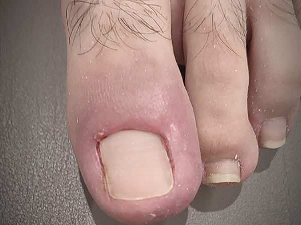 cirugia ungueal