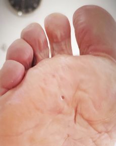 Quiropodia
