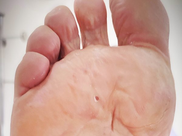 callos en los pies