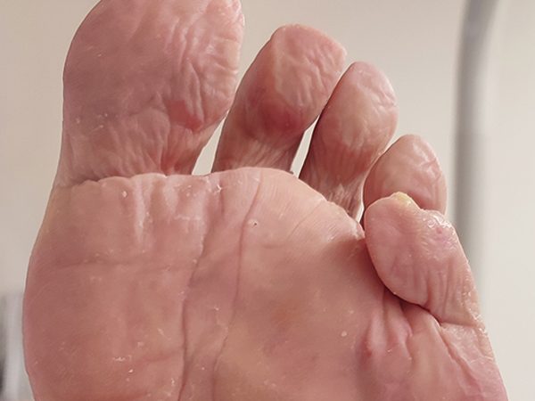 durezas en los pies que duelen