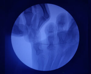 radiografia-con-testigo-callo