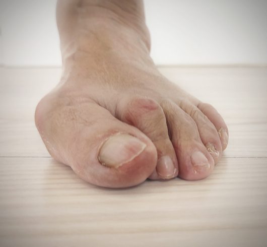 hallux valgus