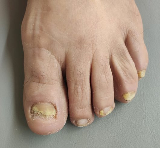 hongos en los pies
