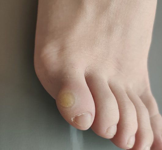 papiloma en los pies